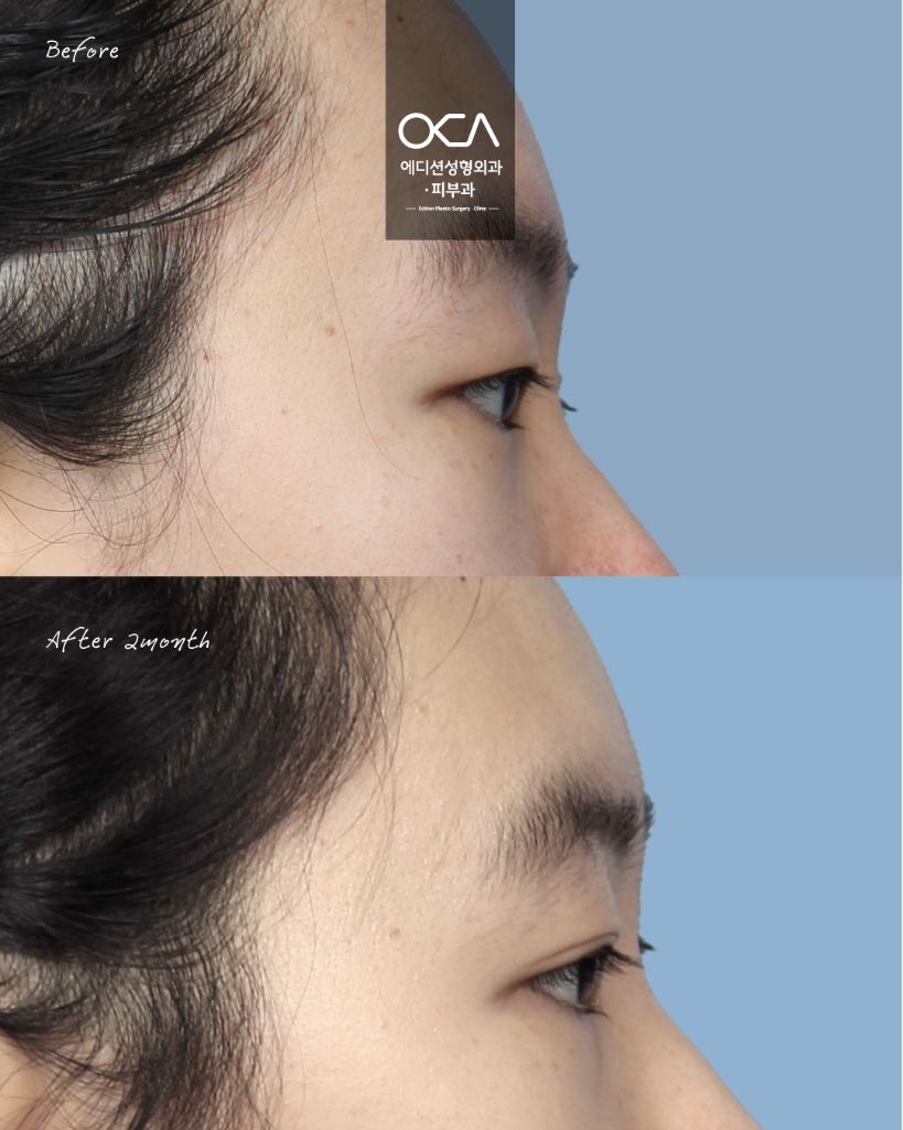 Double Eyelid Result 1