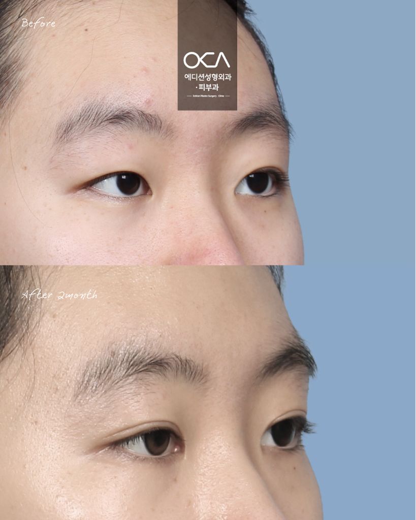 Double Eyelid Result 2