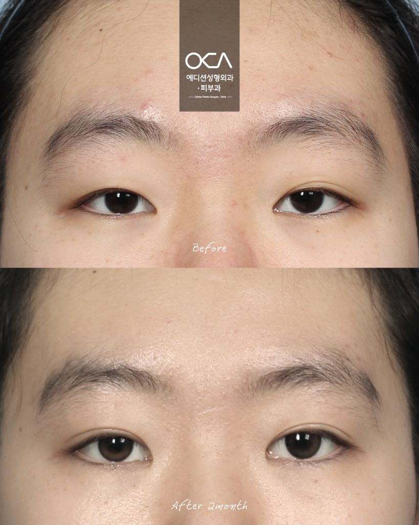 Double Eyelid Result 3