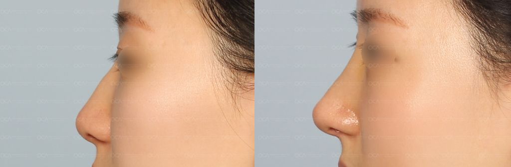 Rhinoplasty Result 1-1