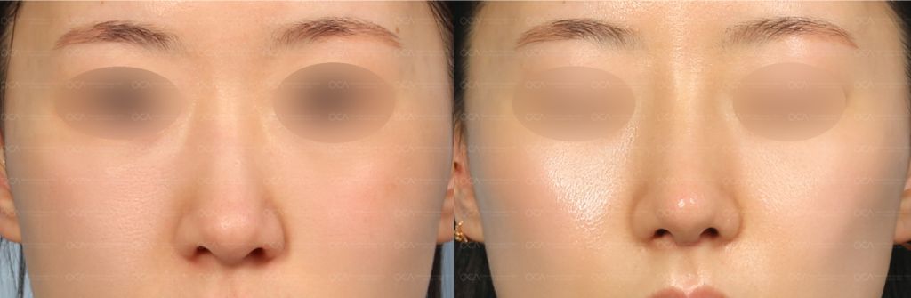Rhinoplasty Result 1-2