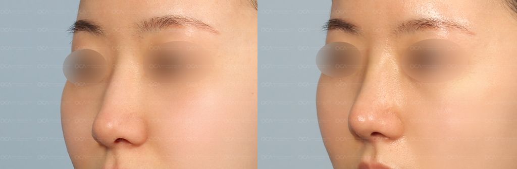 Rhinoplasty Result 1-3