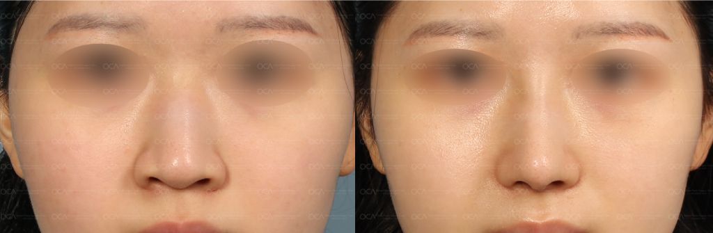 Rhinoplasty Result 2-1
