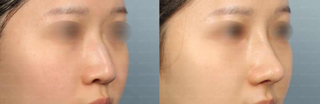 Rhinoplasty Result 2-2