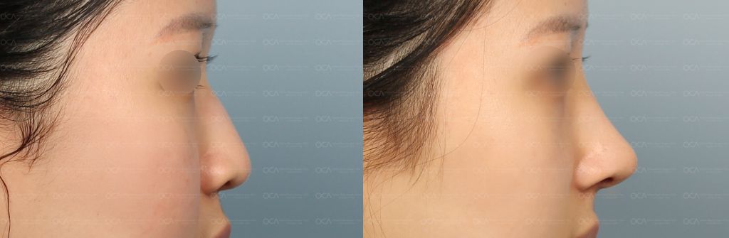 Rhinoplasty Result 2-3
