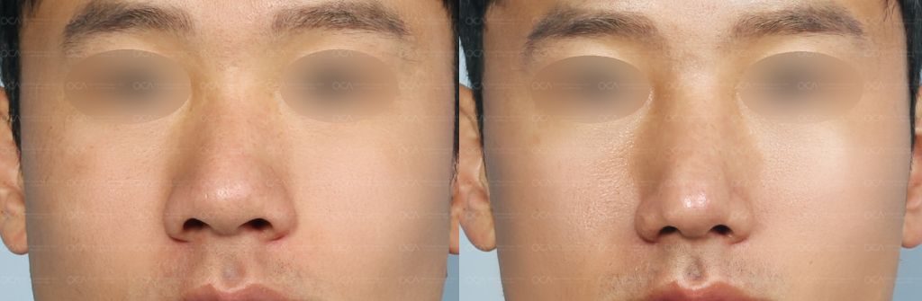 Rhinoplasty Result 3-2