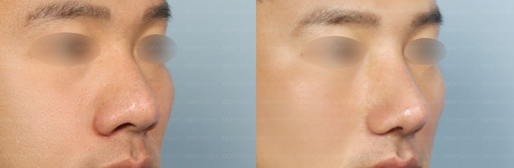 Rhinoplasty Result 3-3
