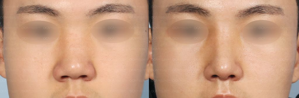 Rhinoplasty Result 4-1