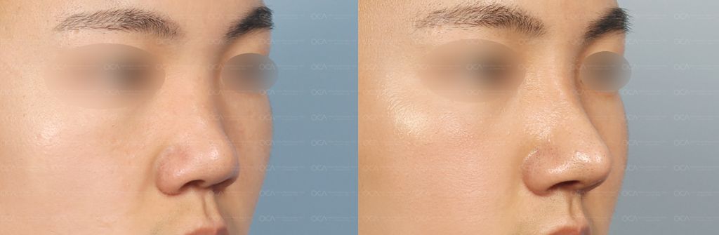 Rhinoplasty Result 4-2