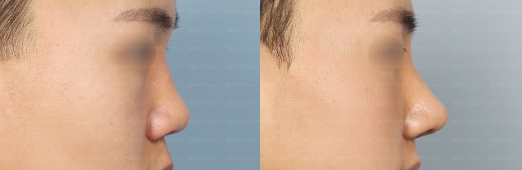 Rhinoplasty Result 4-3