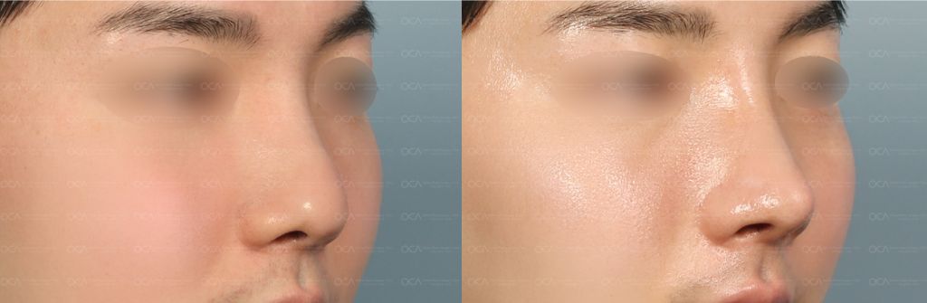 Rhinoplasty Result 5-1