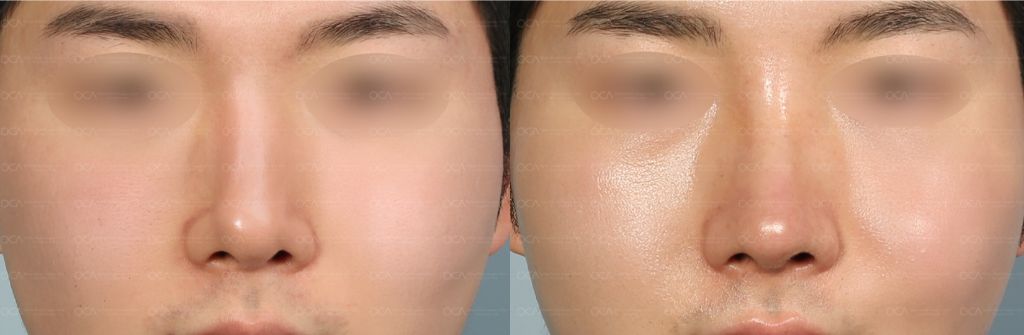 Rhinoplasty Result 5-2