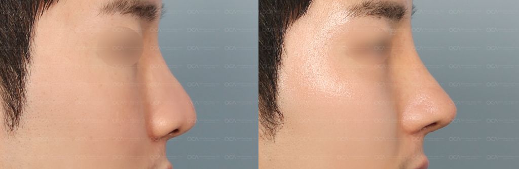 Rhinoplasty Result 5-3