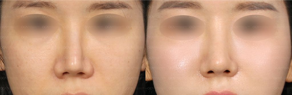 Rhinoplasty Result 6-1