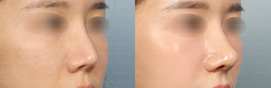 Rhinoplasty Result 6-2