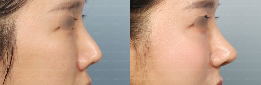 Rhinoplasty Result 6-3