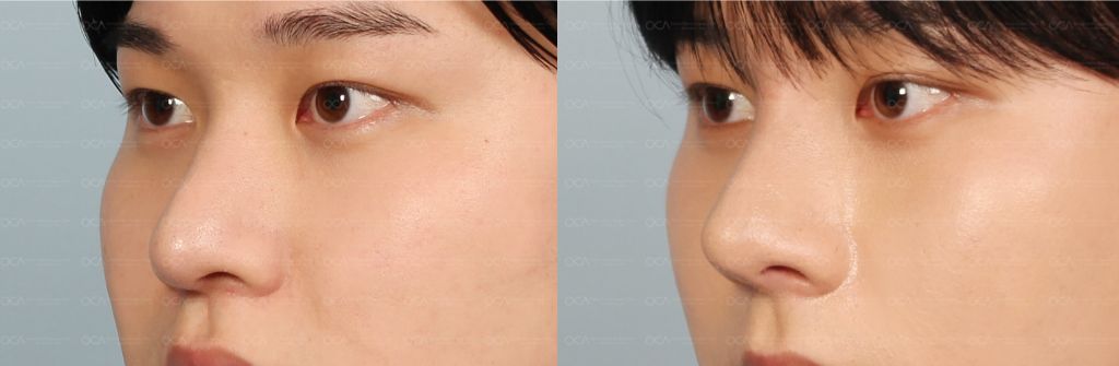 Rhinoplasty Result 7-1