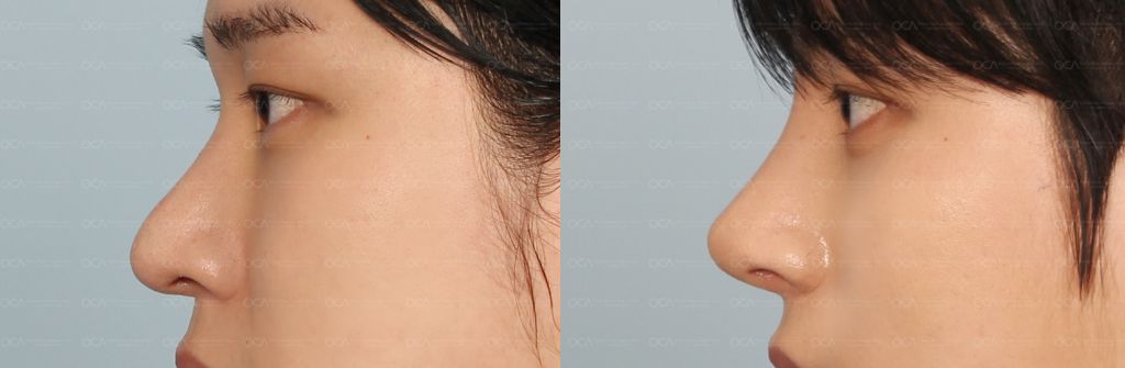 Rhinoplasty Result 7-2