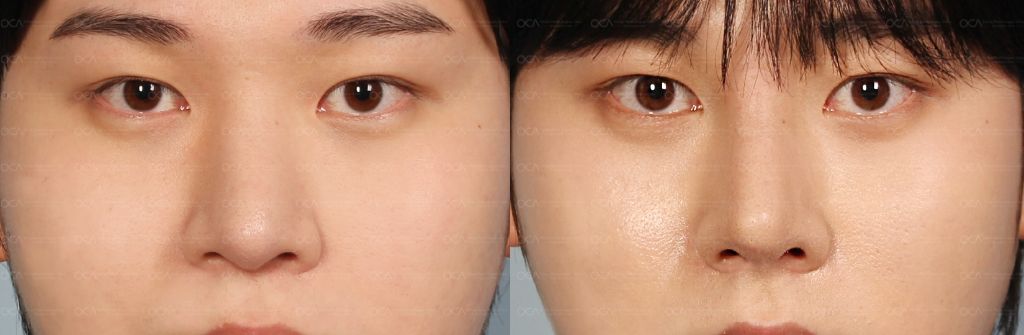 Rhinoplasty Result 7-3
