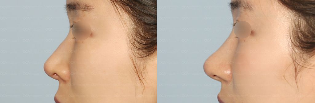 Rhinoplasty Result 8-1