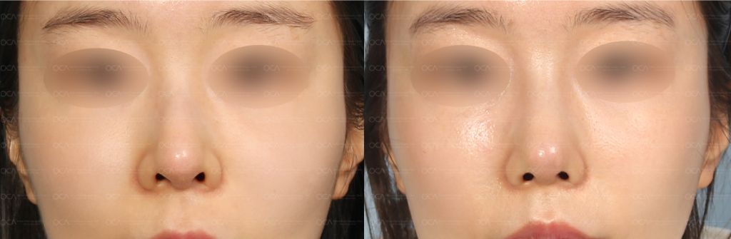Rhinoplasty Result 8-2