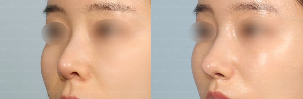 Rhinoplasty Result 8-3