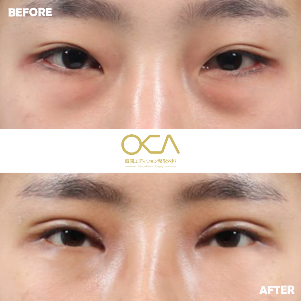 Under Eye Fat Repositioning Result 1