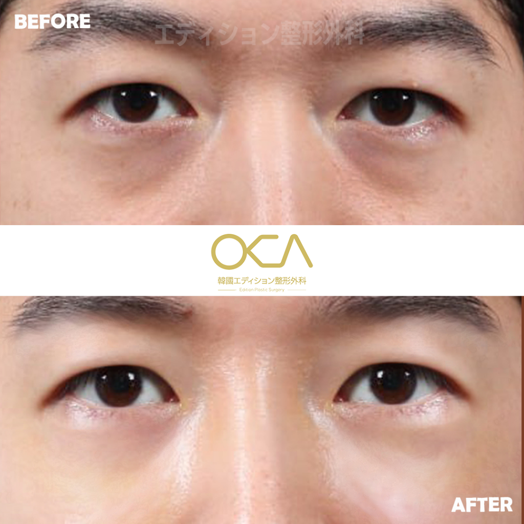 Under Eye Fat Repositioning Result 2