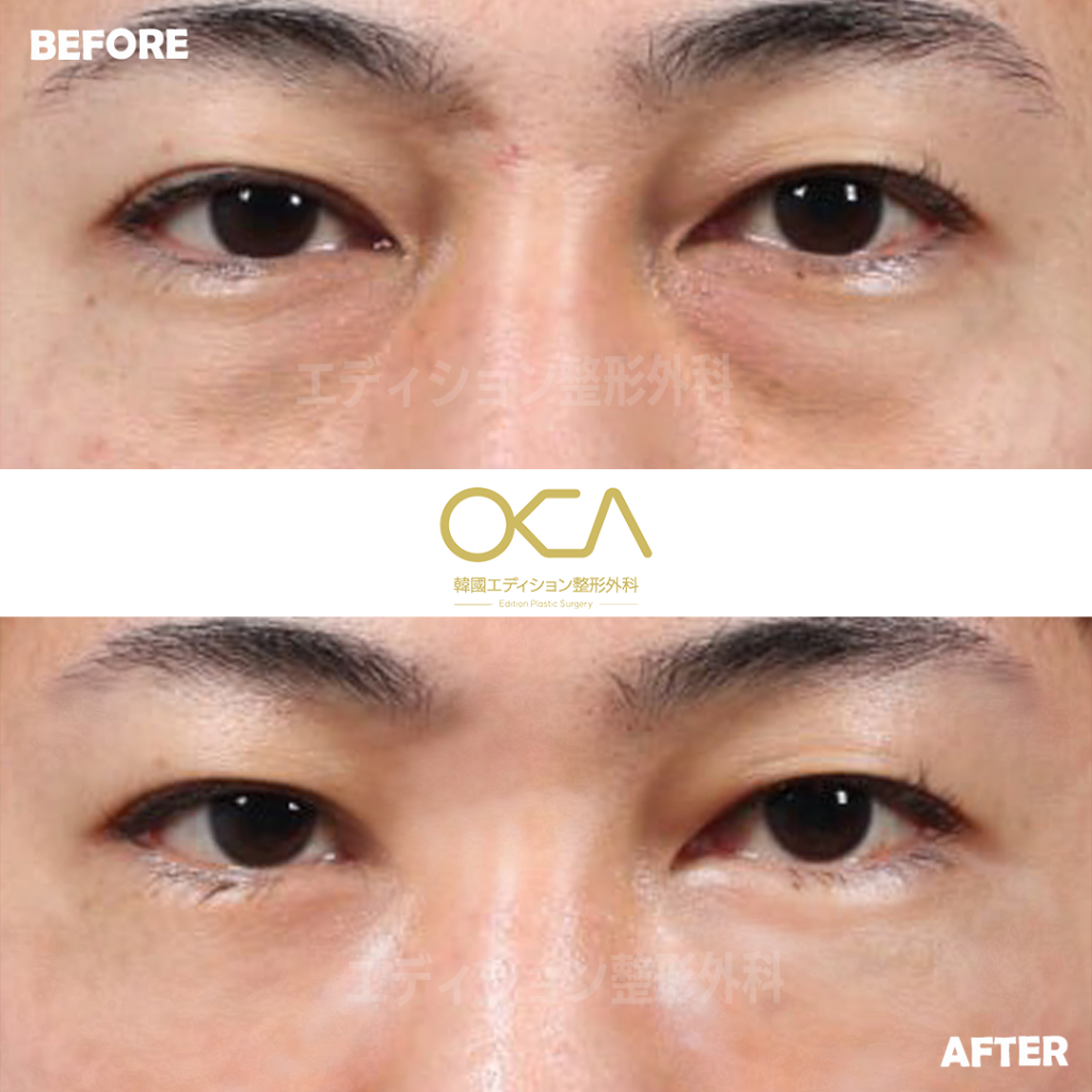 Under Eye Fat Repositioning Result 3