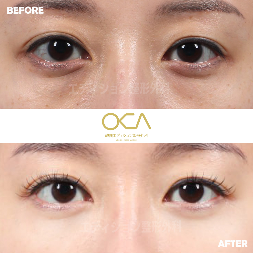 Under Eye Fat Repositioning Result 4